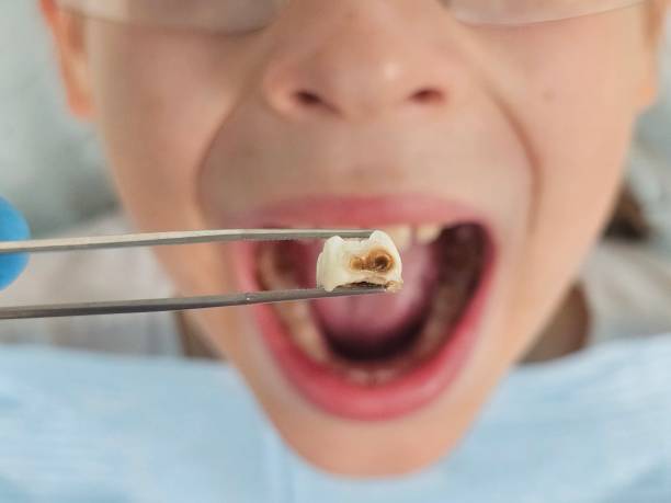 Best Emergency Wisdom Teeth Removal in Cascade, ID
